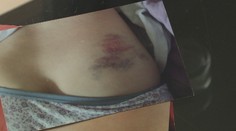 Trikrát ju z pohotovosti poslali domov. Chrbticu zlomenú na dvoch miestach si nevšimli