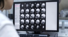 Revolúcia v liečbe agresívneho nádoru na mozgu. Vedci prišli na to, ako lepšie rozoznať zdravé tkanivo od zasiahnutého