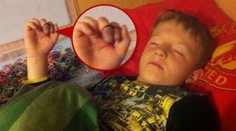 Gumičková závislosť: Školák (8) takmer prišiel o prsty