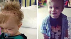 Lekári skladali chlapcovi lebku ako puzzle. Takto vyzdravel