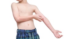 Zo Sačurova hospitalizovali tri deti s podozrením na osýpky