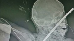 Chlapček prežil hrozné zranenie. Spadol do studne, kovová tyč mu prepichla aj oko