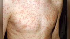 U dvoch Slovákov, ktorí pracujú v Rakúsku, sa objavili osýpky