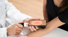 Rýchlejšia diagnostika rakoviny kože vďaka novému objektívu. Pripojiť sa dá na smartphone