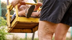 Krčové žily: Komu hrozia a ako sa im môžete vyhnúť