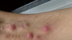 Neliečiteľné ochorenie kože trápi každého stého človeka. Vedci prišli na zaujímavú súvislosť