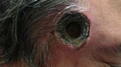 Muž používal výrobok alternatívnej medicíny. Teraz má dieru v hlave