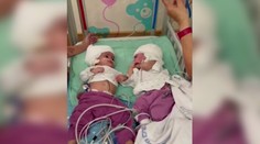 Zriedkavá operácia sa podarila: Siamské dvojičky sa videli prvýkrát tvárou v tvár