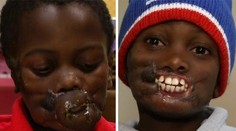 Šimpanzy mu znetvorili tvár. Dnes má za sebou prvú operáciu