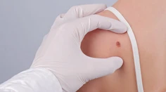 Nebezpečnej rakoviny kože z roka na rok pribúda, najviac sú ohrozené ženy