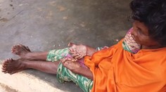 Žena trpí vzácnou anomáliou. Nadmerný počet prstov z nej robí rekordérku