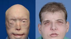 Najväčšia transplantácia v histórii! Popálený hasič má novú tvár