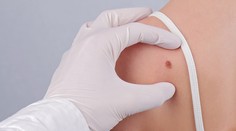 Neviete, či sú vaše znamienka bezpečné? Prinášame vám rozhovor s dermatologičkou