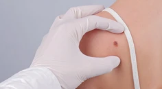 Trápia vás znamienka? Teraz je ideálny čas na ich vyšetrenie a odstránenie