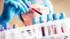 Vedci vyvinuli test, ktorý dokáže odhaliť rakovinu roky predtým, než sa ukážu príznaky