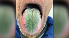 Lekári opísali bizarný prípad: Mužovi sa na jazyku vytvoril zelený povlak pripomínajúci srsť