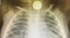 Bábätko mesiace odmietalo stravu, lekári nevedeli prečo. Všetko odhalil až röntgen