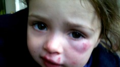 Dievčatko (2) brutálne dobila jej kamarátka v škôlke