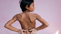 Chlapcovi (13) narástol prasací chvostík