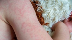 Osýpky nie sú banálne ochorenie. Pre jednu skupinu pacientov môže byť fatálne