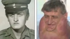 Slovákovi odstránili šesťkilový tumor. Píšu o ňom aj vo svete!