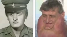 Slovákovi odstránili šesťkilový tumor. Píšu o ňom aj vo svete!