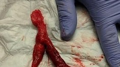 Muž sa sťažoval na bolesť chrbta a nevoľnosť: V pľúcach mu našli obrovskú zrazeninu