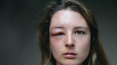 Nevyspytateľné opuchy, bolesti a riziko zadusenia. Čo je to heditárny angioedém a koho postihuje?