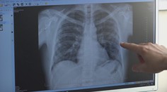 Na následky respiračných ochorení zomierajú stovky ľudí. Pred touto sezónou varujú odborníci