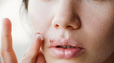 Bolestivé opary: Zistite, prečo vznikajú a ako ich môžete účinne vyliečiť