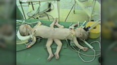 Úspechy za 25 rokov: Slovák sa pozrel do vesmíru, lekári dokázali oddeliť siamske dvojčatá