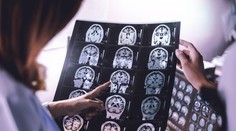 Prichádza náhle a postihuje aj zdravých ľudí. Lekárka upozornila na tri najčastejšie príznaky mŕtvice