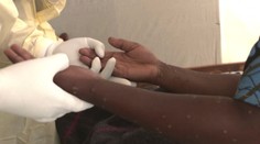 Horúčka, bolesť svalov i vyrážky. Odborník priblížil, ako sa šíria opičie kiahne