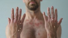 Zisťovali sme viac o pacientoch infikovaných opičími kiahňami. Prvý je už vyliečený