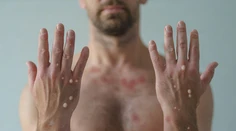 WHO mení názov opičích kiahní. Chce sa vyhnúť stigmatizácii