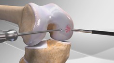 K ortopédom so zničenými kolenami chodí čoraz viac mladých ľudí. Riešením nemusí byť už iba umelá náhrada