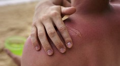 Často podceňovaná rakovina kože: Lekár radí, ako sa o kožu najmä v lete starať, aby sme sa jej vyhli