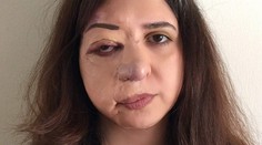 Roky si o nej mysleli, že má nákazlivú chorobu. Ľudia nechceli, aby vychádzala z domu