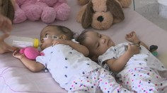 Ako sa darí dvojičkám z Bhutánu, ktoré oddelili?