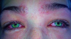 Mladá žena takmer oslepla po farbení obočia, vôbec o svojej alergii nevedela