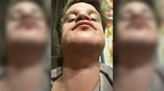 Žena chcela priateľovi natrieť bradu farbou na vlasy. Bizarný nápad skončil popáleninami