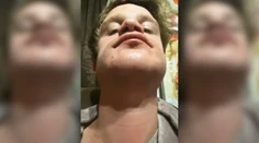 Žena chcela priateľovi natrieť bradu farbou na vlasy. Bizarný nápad skončil popáleninami