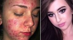 Tínedžerka trpela hrozným akné. Takto ho dokázala maskovať