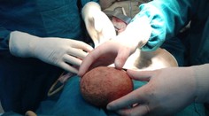 Mužovi vytiahli z tela najväčší močový kameň všetkých čias