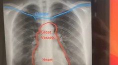 Tínedžerku (19) dlhšie trápil kašeľ. Následné röntgenové vyšetrenie odhalilo nečakanú anomáliu