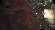 Šokujúce video: Muž mal v nose 100 mäsožravých červov