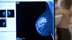 Štúdia spochybnila význam mamografického vyšetrenia prsníka