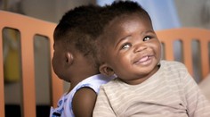 Unikátny zákrok: Siamské dvojičky zrastené lebkami oddelili po 18-hodinovej operácii