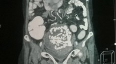 Žene (60) našli v tele 36-ročnú kostru dieťaťa