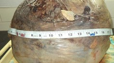 Žena ani netušila, že má v sebe viac ako 13-kilový nádor veľký ako melón